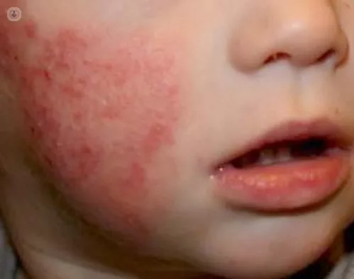 dermatitis atópica niños