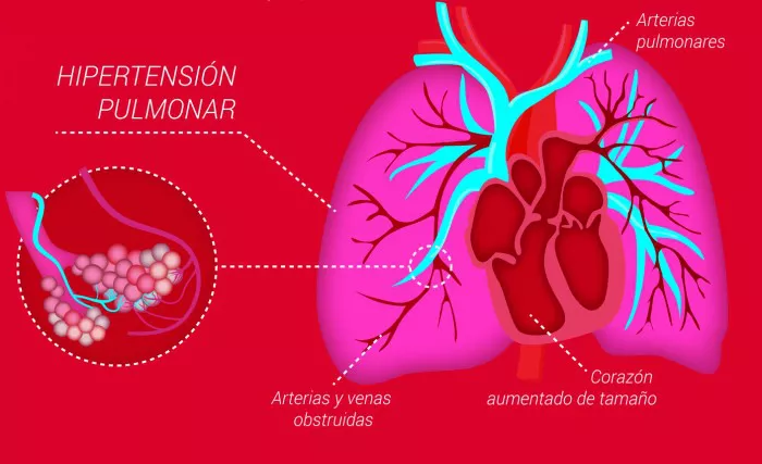 pulmones-y-corazon-con-hipertension-pulmonar-e1429789433932