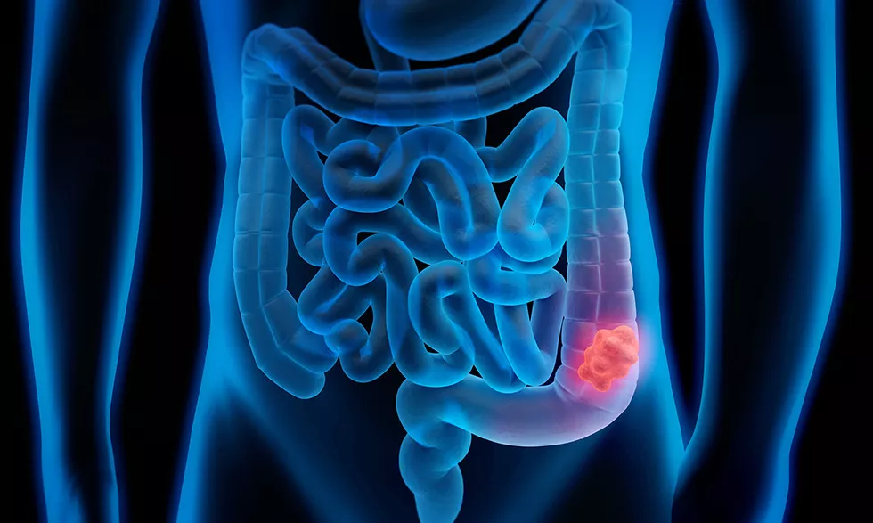Colorrectal Cancer