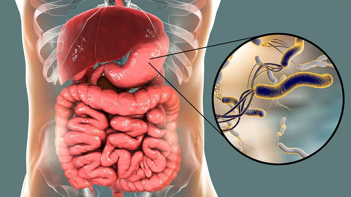 La-infeccion-por-Helicobacter-pylori-