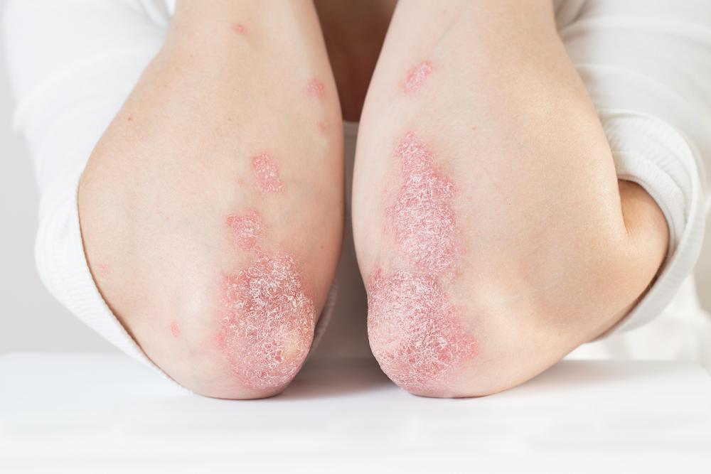 Foto 3 - Mi Psoriasis - Bristol Myers Squibb y AEPSO