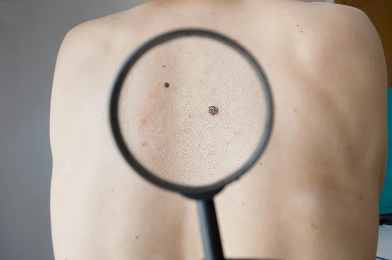 Campaña MelaNOmás 1