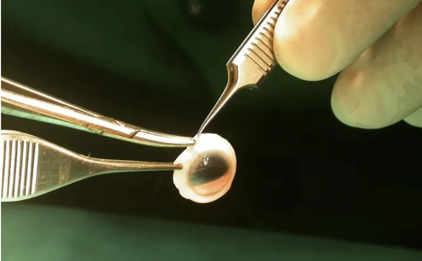cornea transplante