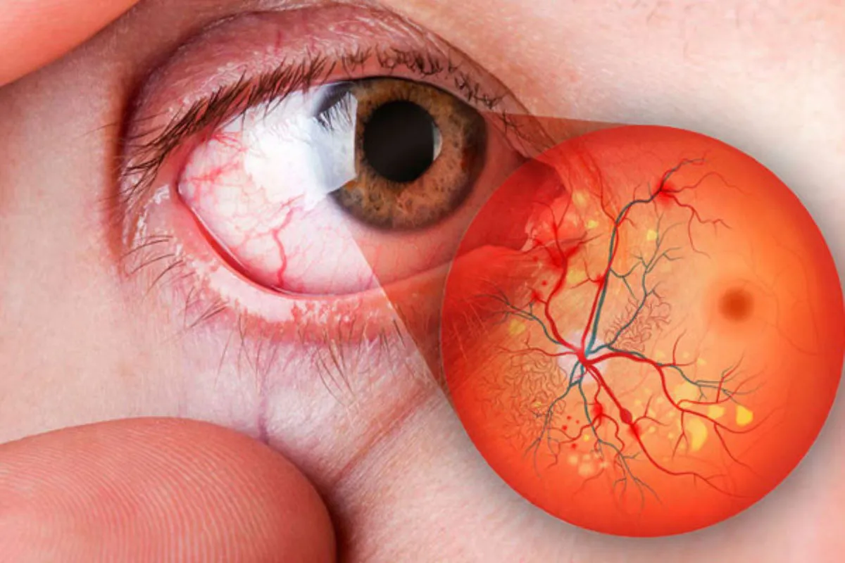 retinopatía diabetica