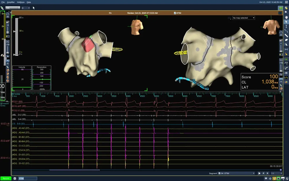 ablacion hosp carrillo 2