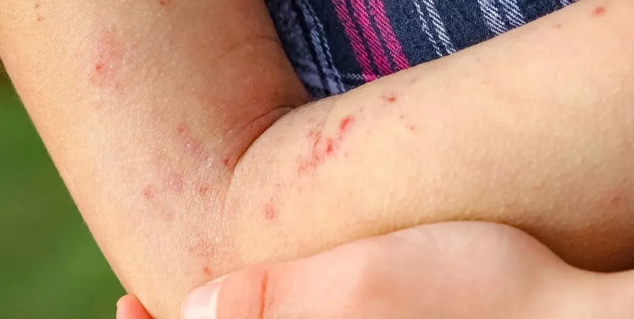 dermatitis atópica