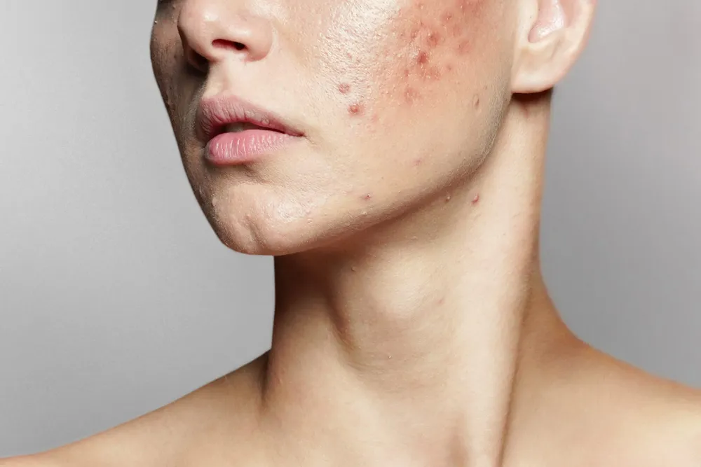 piel con acne