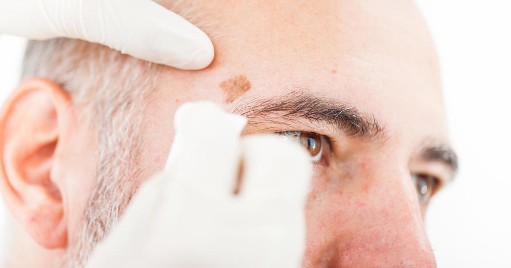 Melanoma-Skin-Cancer-1