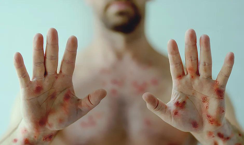 viruela del mono viruela del mono